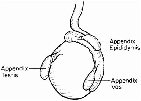 torsion of the appendix testes|Torsion of the Testicular Appendices and Epididymis.